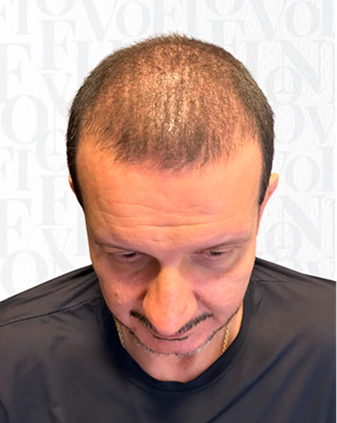 Paciente antes do transplante capilar FUE, com rarefação no topo da cabeça