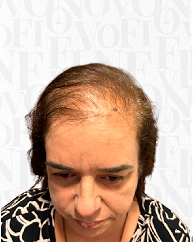 Paciente mulher antes do transplante capilar FUE, com rarefação na linha frontal